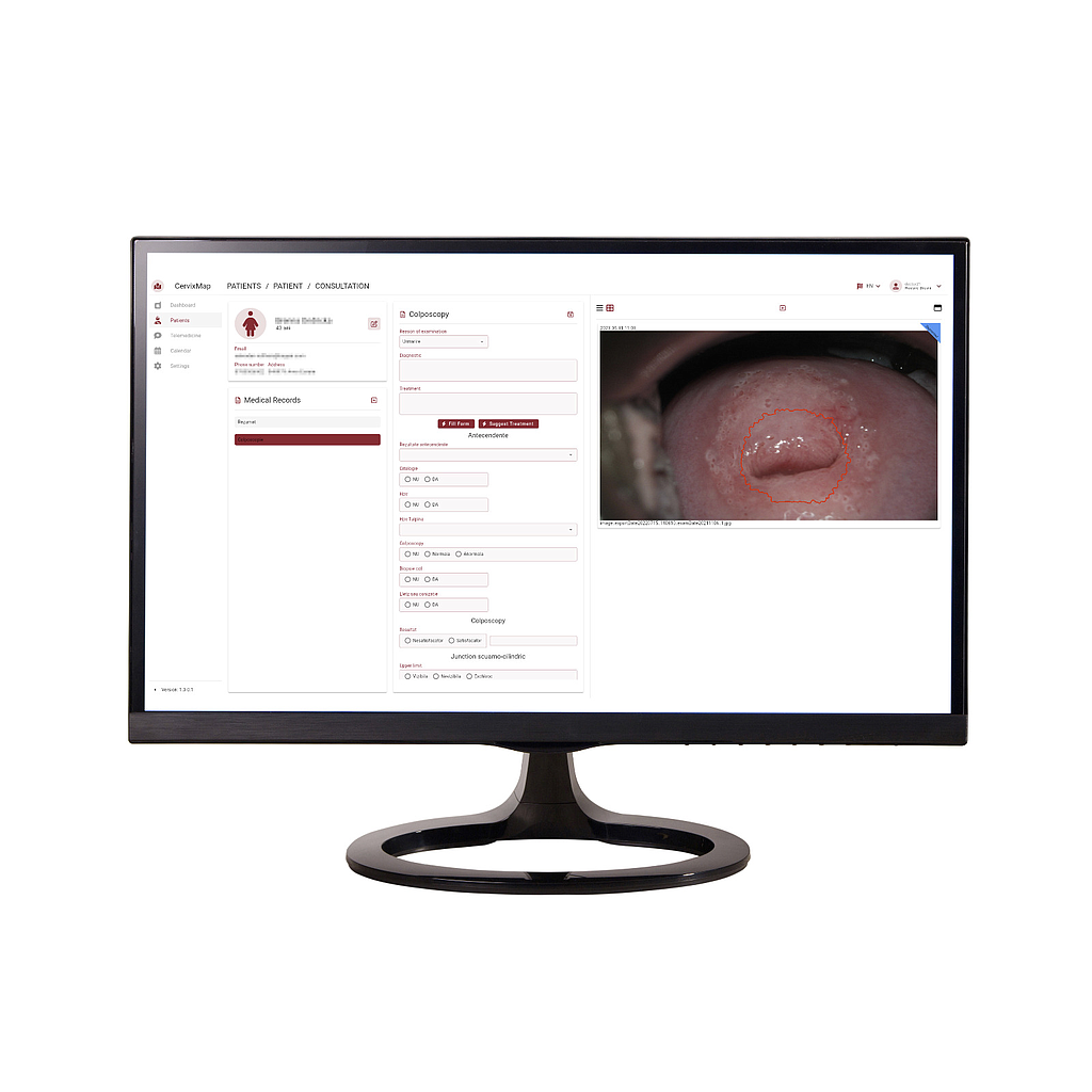 Software recunoaștere leziuni col uterin - CervixMap